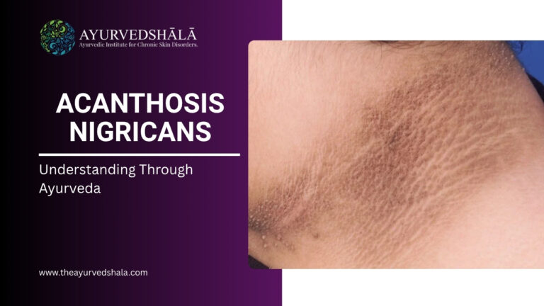 Home 1 Acanthosis Nigricans