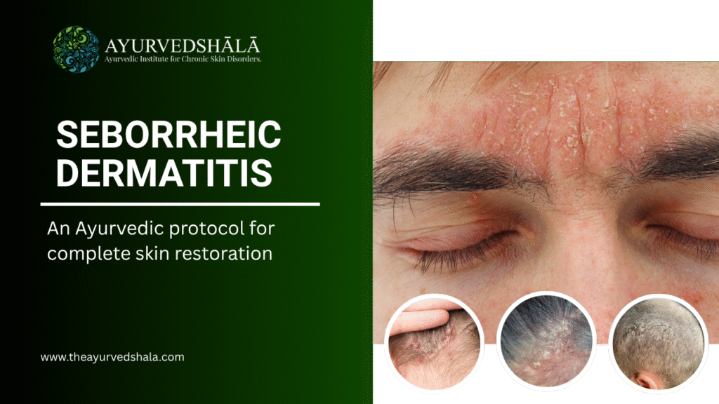 Seborrheic Dermatitis