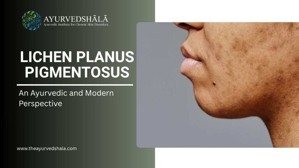 Lichen Planus Pigmentosus: An Ayurvedic and Modern Perspective 1 Lichen Planus Pigmentosus
