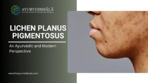 Lichen Planus Pigmentosus: An Ayurvedic and Modern Perspective