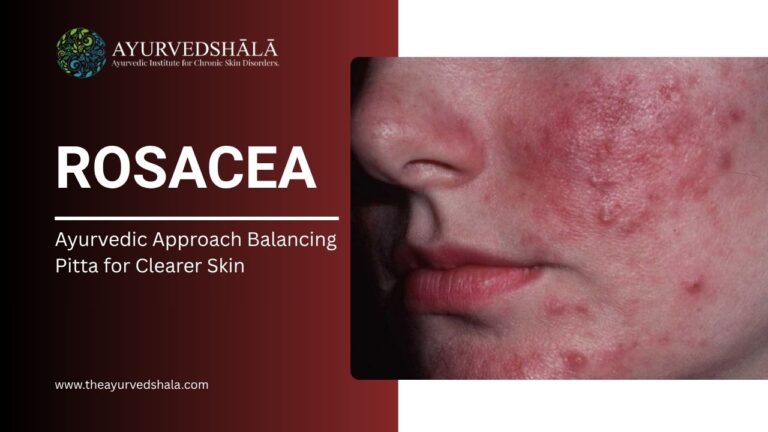 Home 2 Rosacea