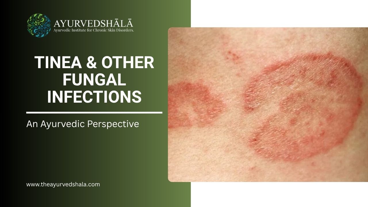 Tinea & Other Fungal Infections