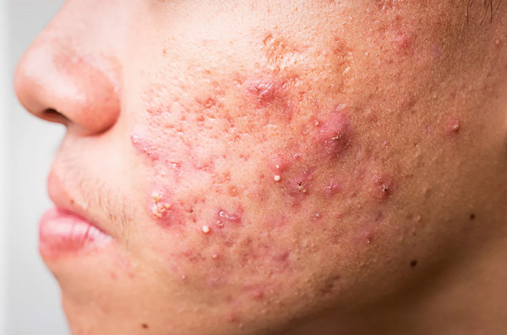 Acne Vulgaris: An Ayurvedic Perspective 1 Acne Vulgaris