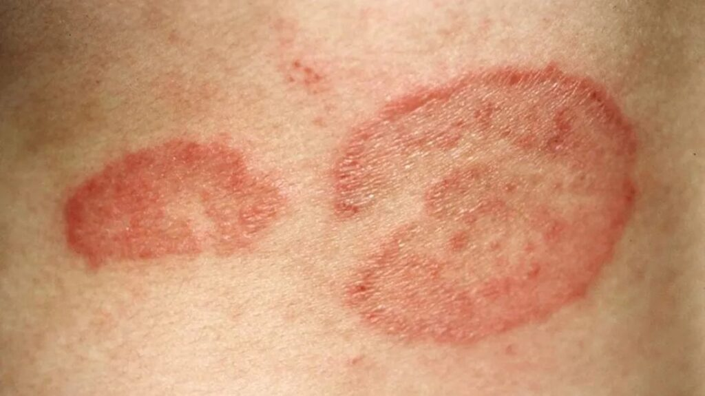 Tinea and Other Fungal Infections: An Ayurvedic Perspective 1 image