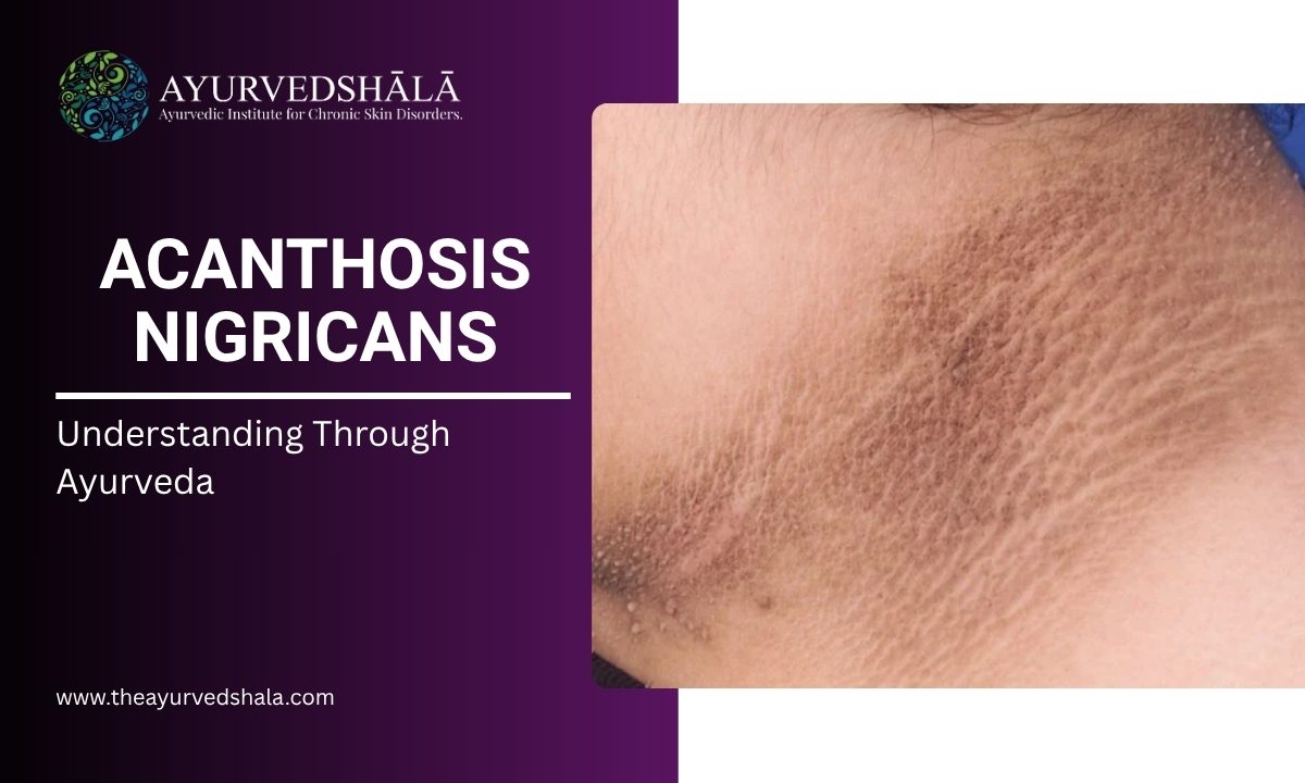Acanthosis Nigricans