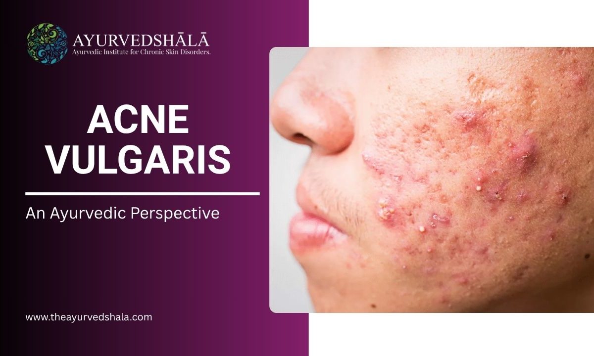 Acne Vulgaris