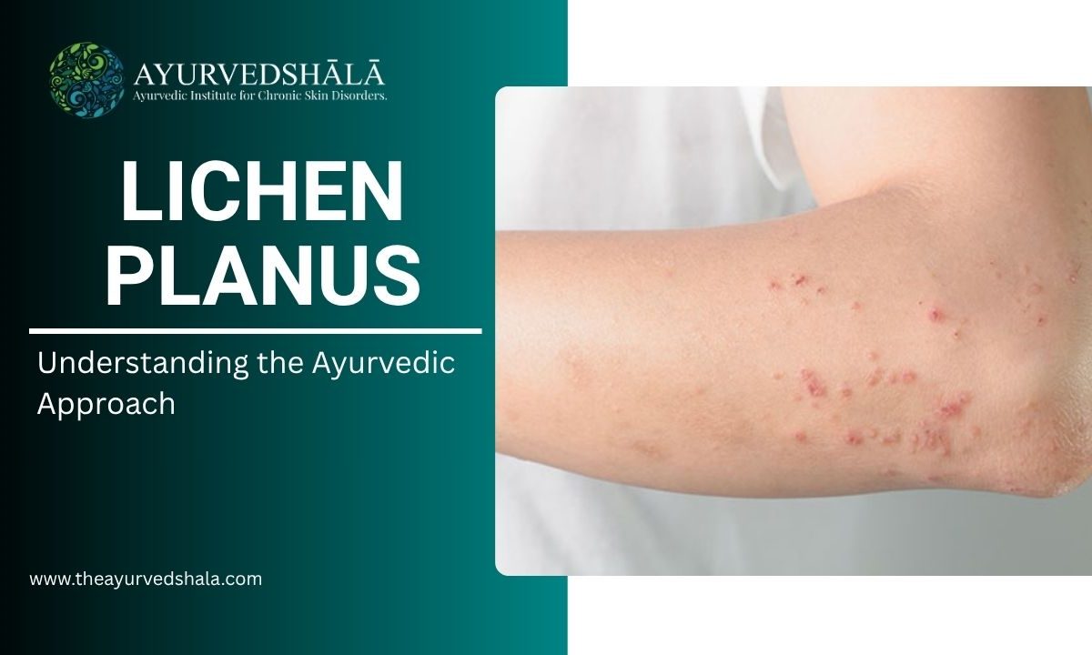 Lichen planus