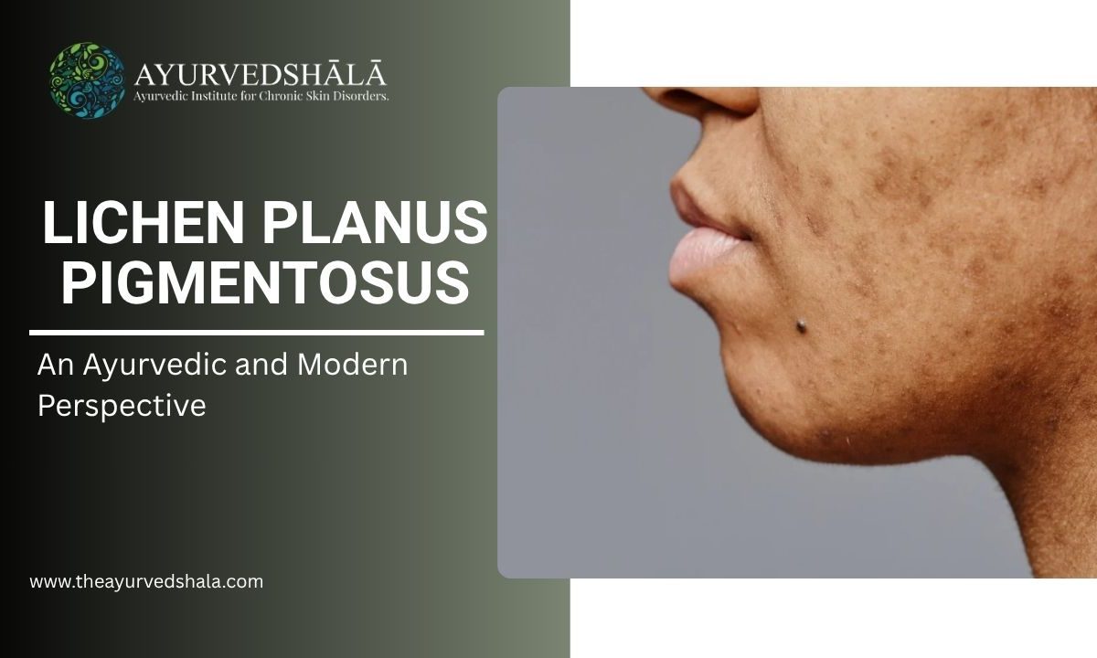 Lichen Planus Pigmentosus
