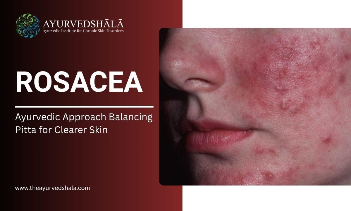 Rosacea