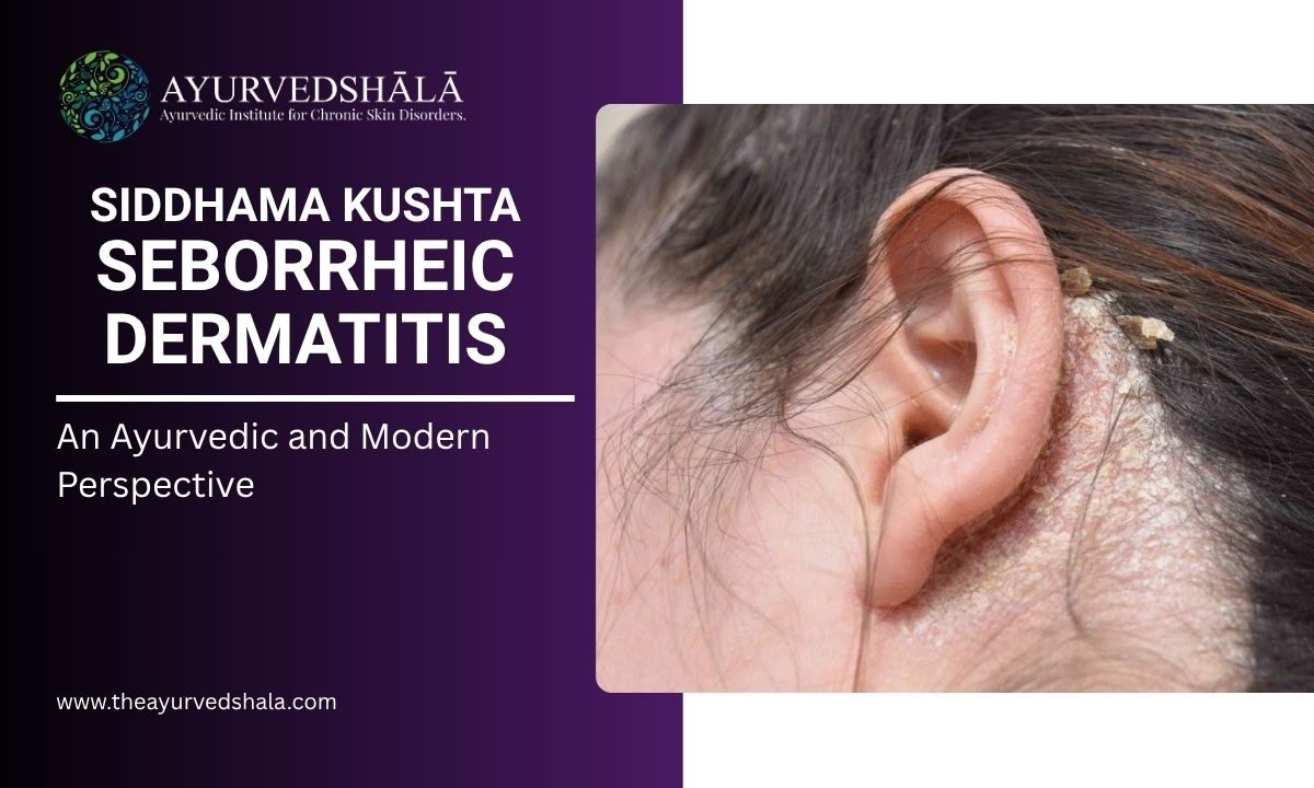 Siddhama Kushta Seborrheic Dermatitis