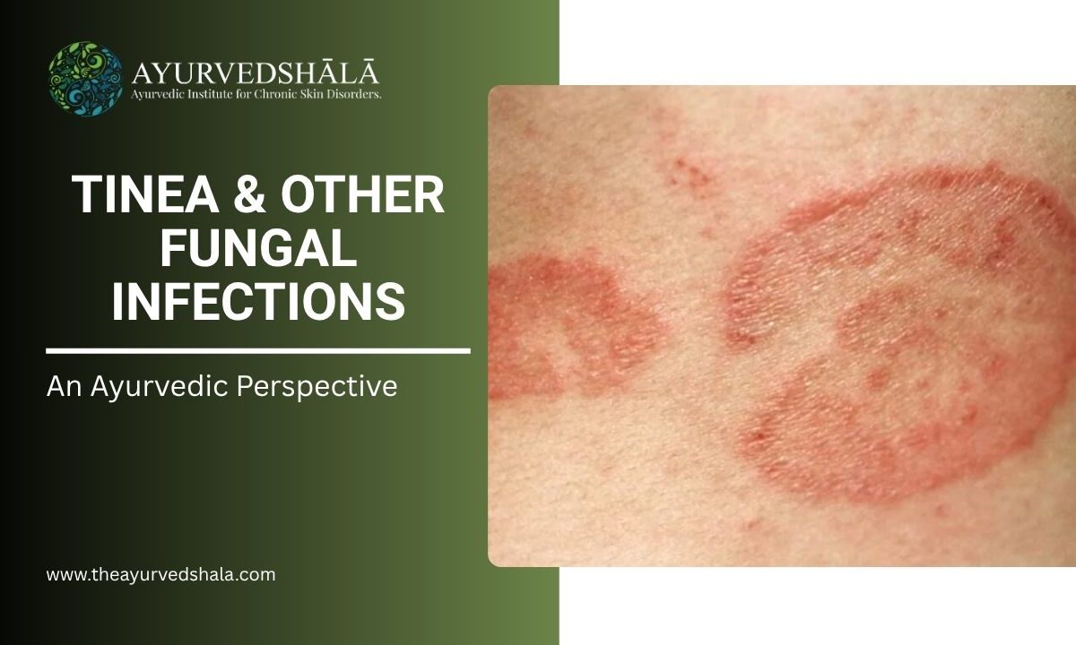 Tinea & Other Fungal Infections